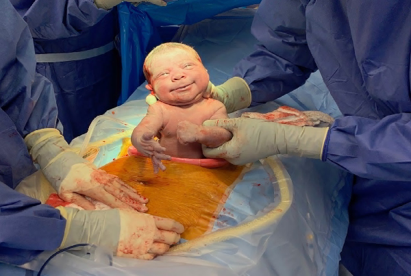 Caesarean Section