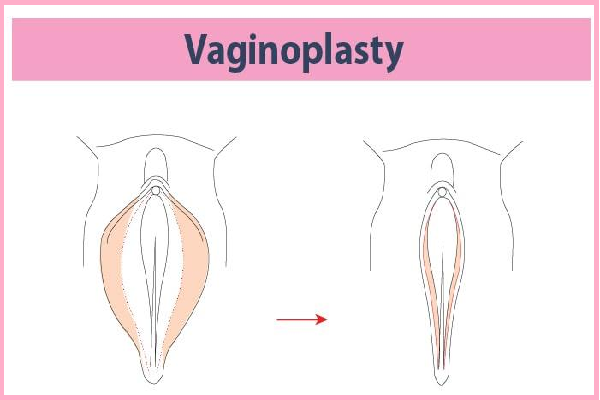 Vaginoplasty and Labioplasty