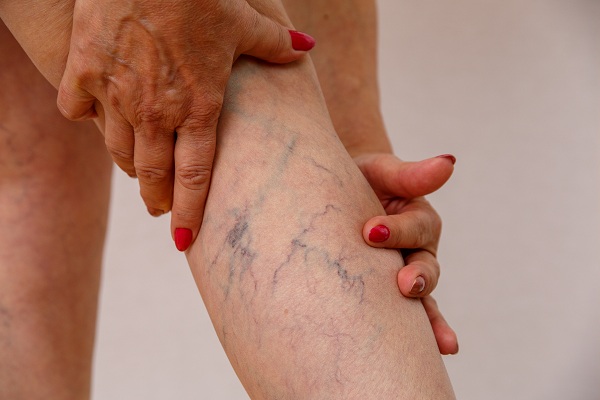 Laser Treatment of Varicose Veins